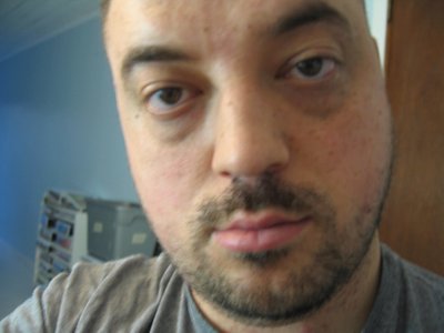 Kidney troubles Eye bags